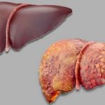 fatty-liver